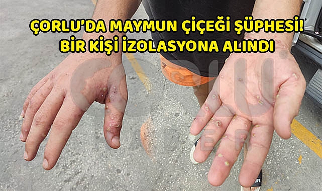 Çorlu'da Maymun Çiçeği Şüphesi! Bir Kişi İzolasyona Alındı